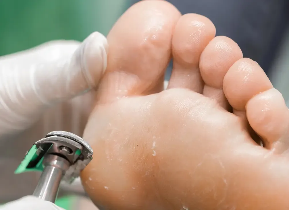 A gloved hand reducing hard skin on the sole of a foot with a podiatry handpiece