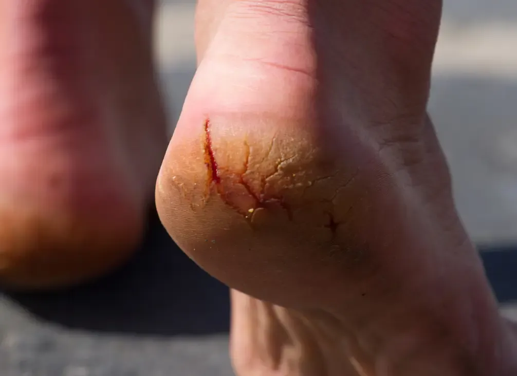 A deep split across the rim of a dry, thickened heel