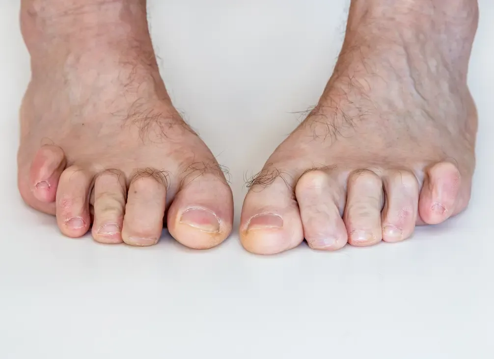 Two bare feet with the smaller toes buckled at the middle joint