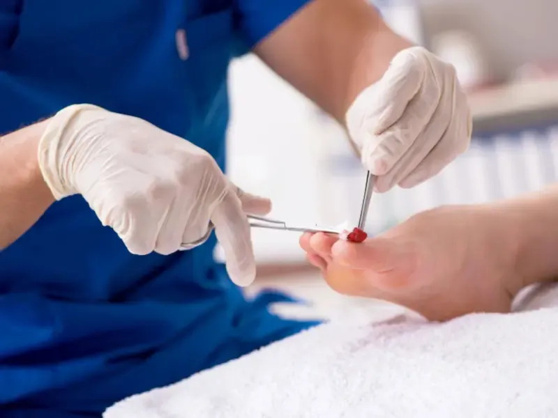 A podiatrist treating an ingrown toenail on a patient's big toe with sterile instruments
