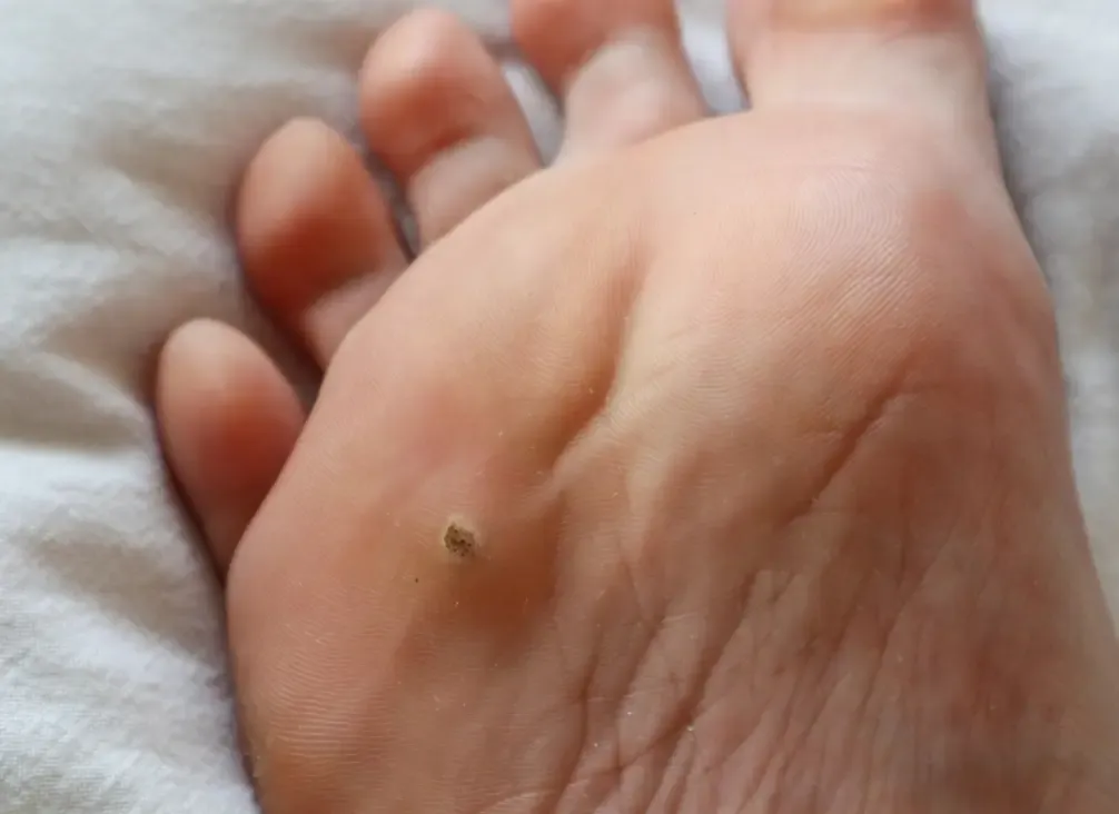A plantar wart on the sole of a foot, showing the characteristic rough surface and dark points