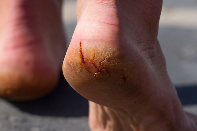 Suffering from ongoing cracked heels? | How to avoid painful skin cracks