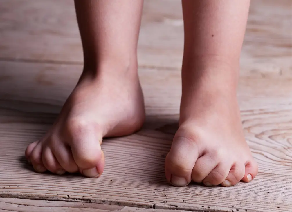 Close-up of child’s feet showing foot deformity or alignment issues needing podiatry care