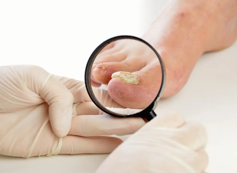 Close-up of fungal toenail under magnifying glass during podiatry exam
