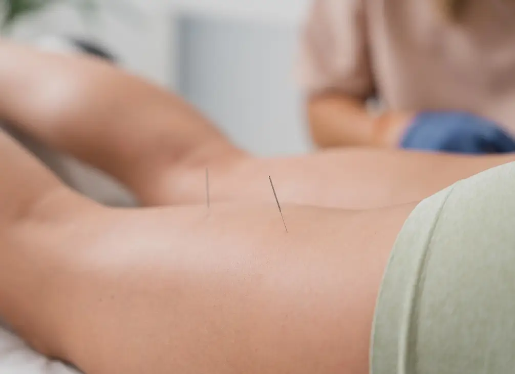 Dry needling in lower limb muscles – podiatry Brunswick treatment for foot and leg pain.