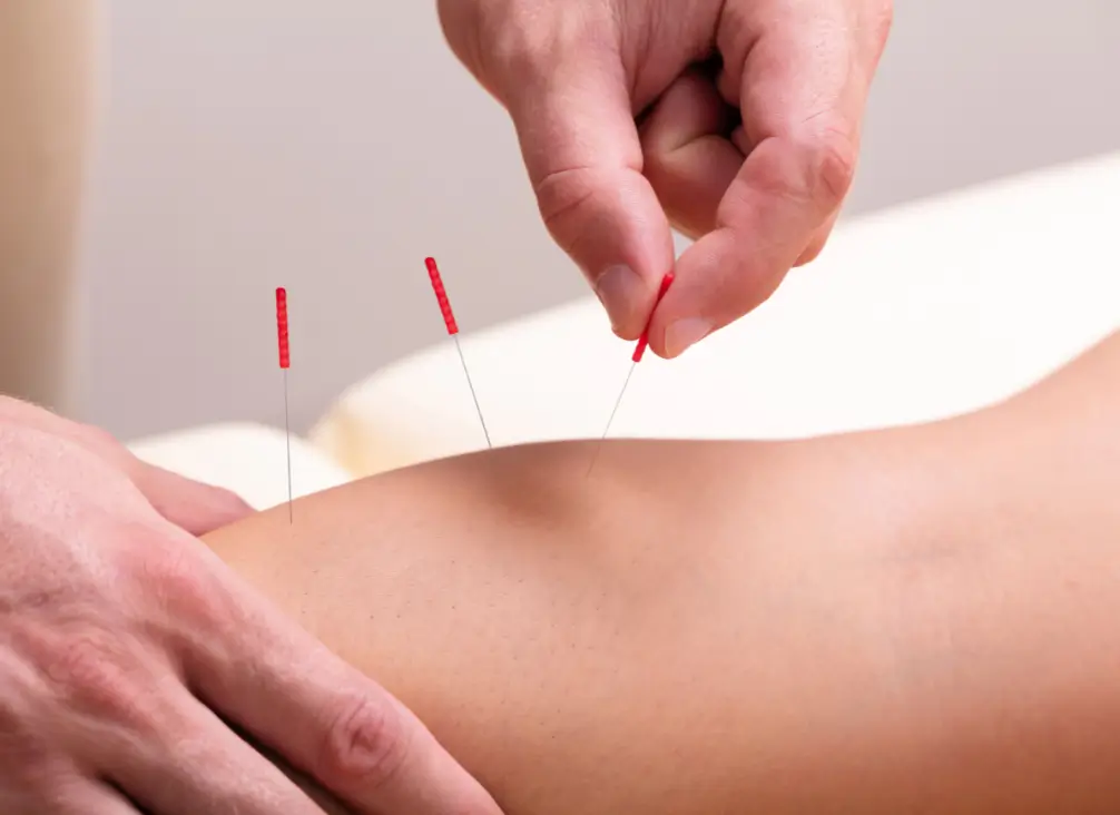 Close-up of dry needling therapy on leg muscles – podiatry Brunswick treatment option.