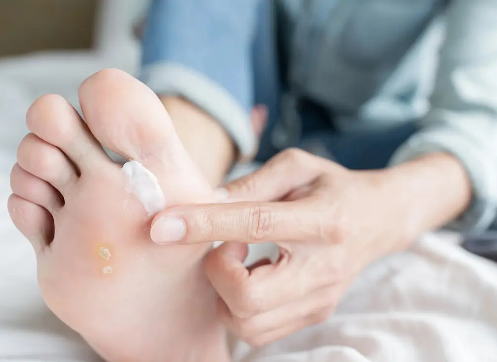 Person applying antifungal cream to foot with tinea infection