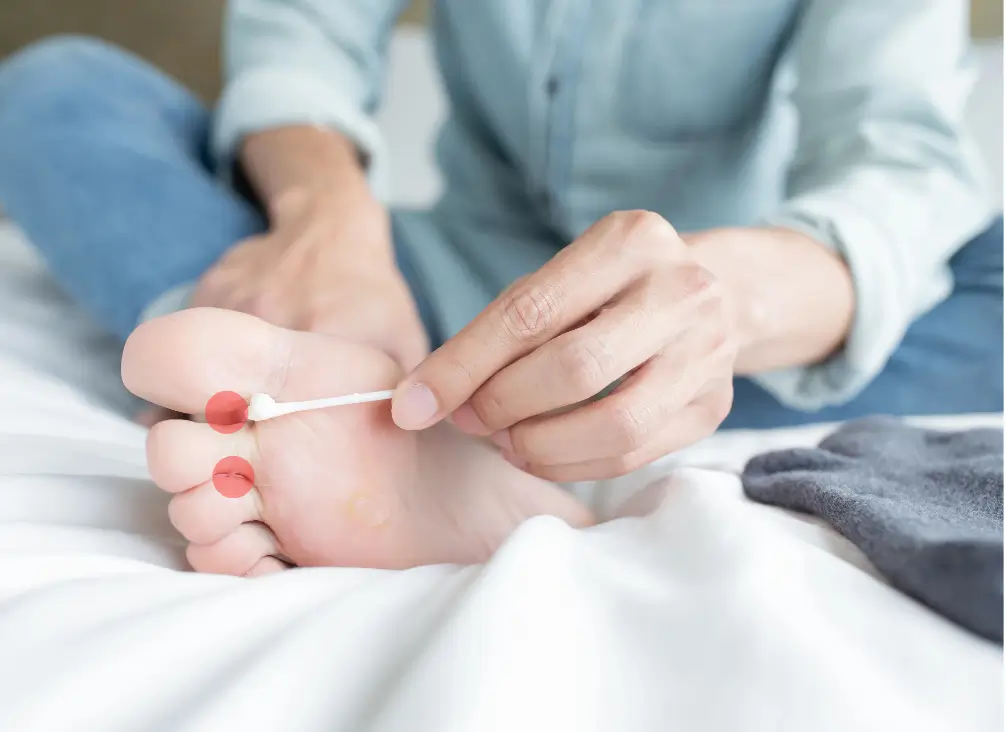 A gloved hand holds a magnifying glass over thickened, discoloured toenails, clearly showing signs of a fungal nail infection. Perfect for podiatry service pages covering fungal nail diagnosis, treatment options, and preventative care