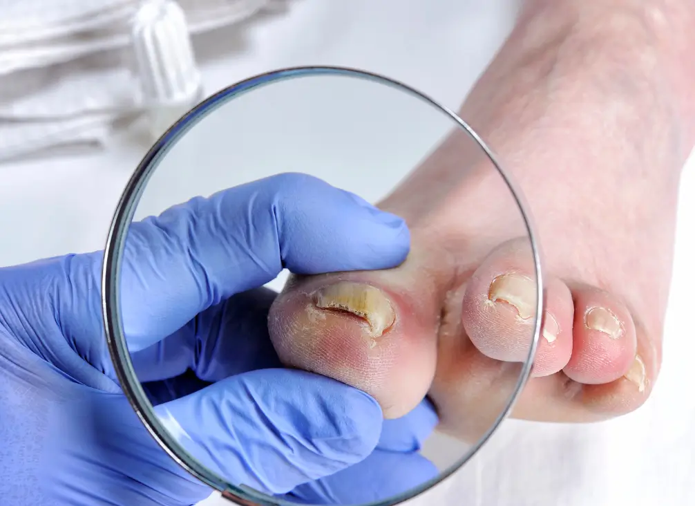 Close-up of fungal toenail infection under magnifying glass