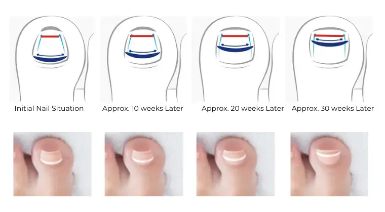 Onyfix nail correction process showing toenail improvement over 30 weeks — from initial curved nail to corrected healthy shape.